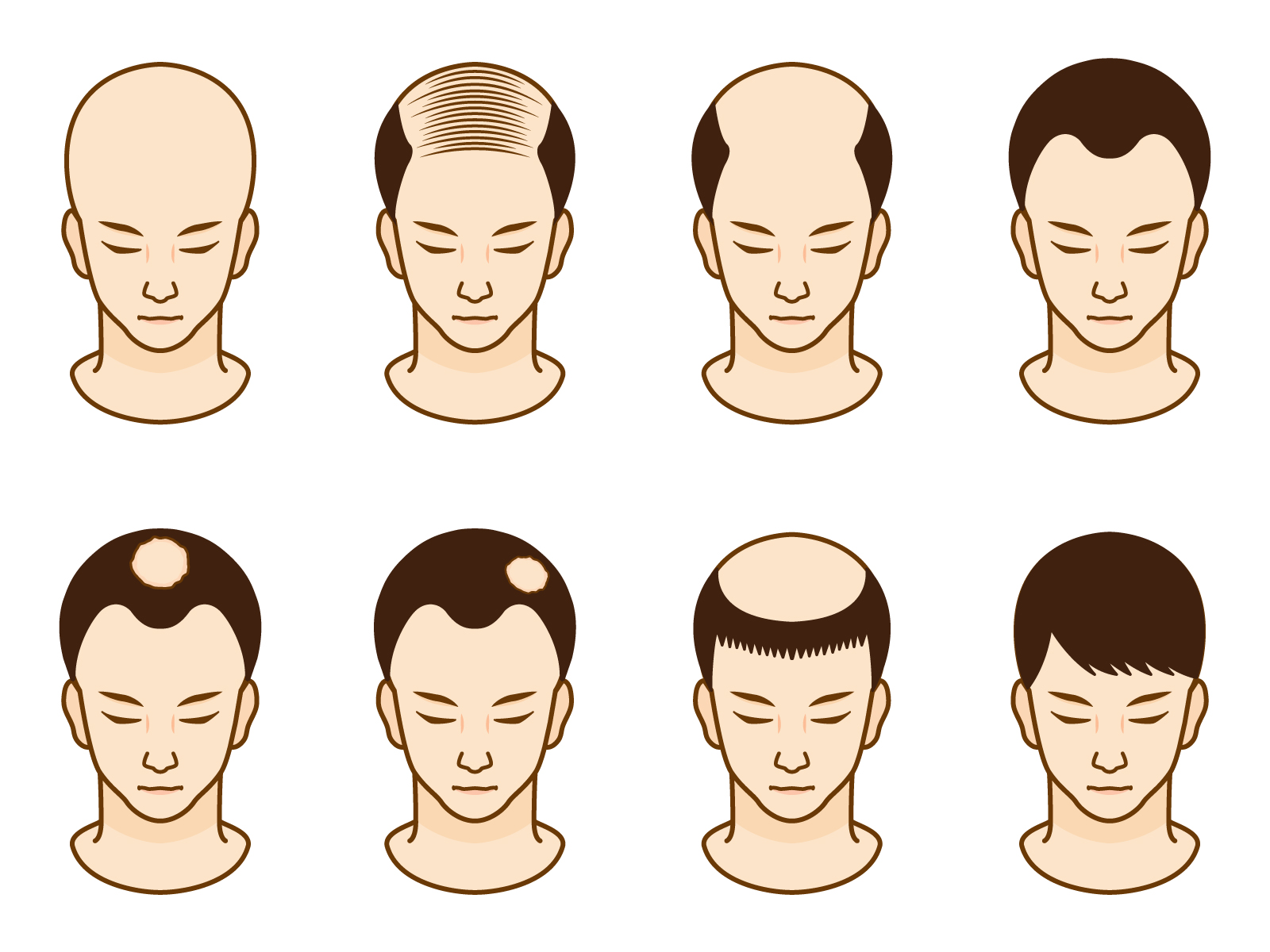 AGA(男性型脱毛症)とは？薄毛治療・発毛効果と原因｜AGAクリニック