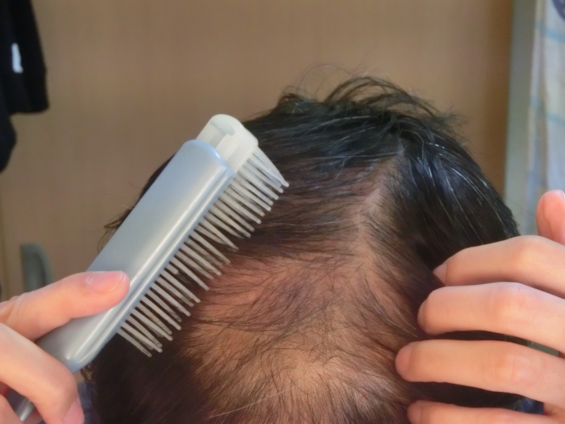 AGAオンライン診療：安い値段で薄毛治療！クリニック比較とおすすめ